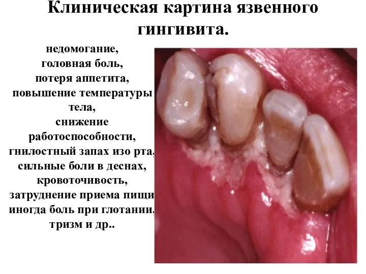 Клиническая картина язвенного гингивита. недомогание, головная боль, потеря аппетита, повышение