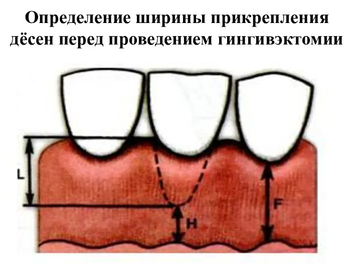 Определение ширины прикрепления дёсен перед проведением гингивэктомии
