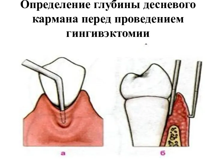 Определение глубины десневого кармана перед проведением гингивэктомии