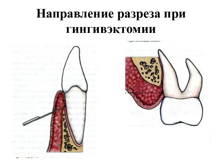 Направление разреза при гингивэктомии