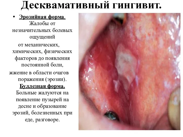 Десквамативный гингивит. Эрозийная форма. Жалобы от незначительных болевых ощущений от