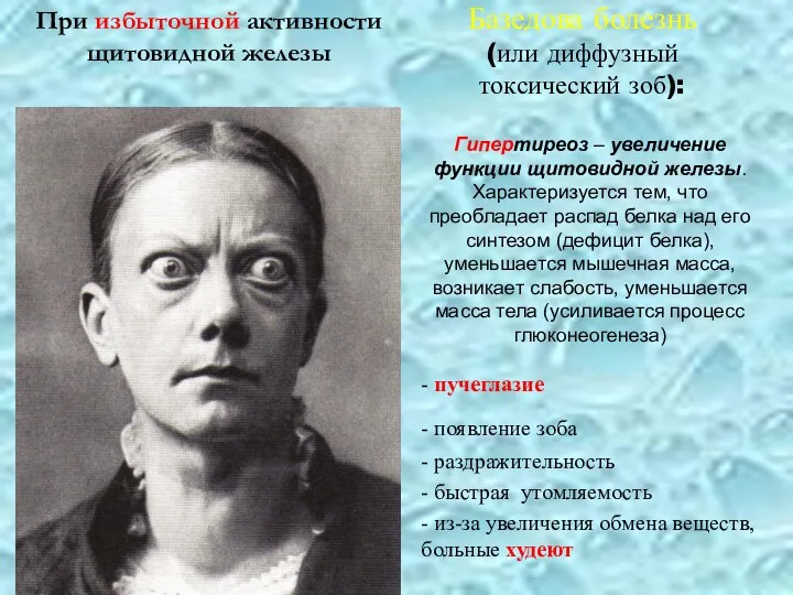 Базедова болезнь (или диффузный токсический зоб): - пучеглазие - появление