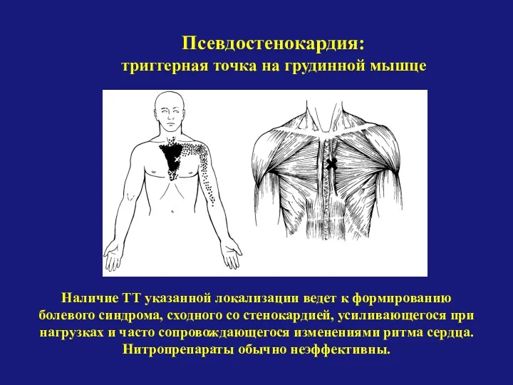 Псевдостенокардия: триггерная точка на грудинной мышце Наличие ТТ указанной локализации