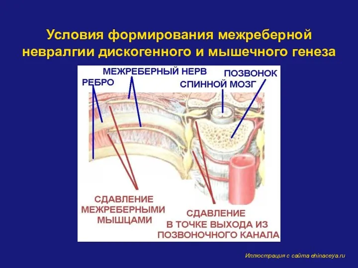 Условия формирования межреберной невралгии дискогенного и мышечного генеза Иллюстрация с сайта ehinaceya.ru