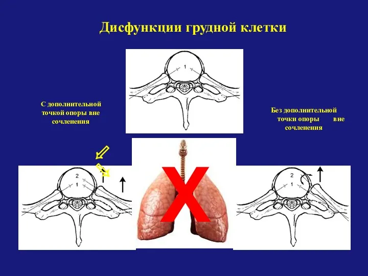 Дисфункции грудной клетки ⬃ ⬂ Без дополнительной точки опоры вне