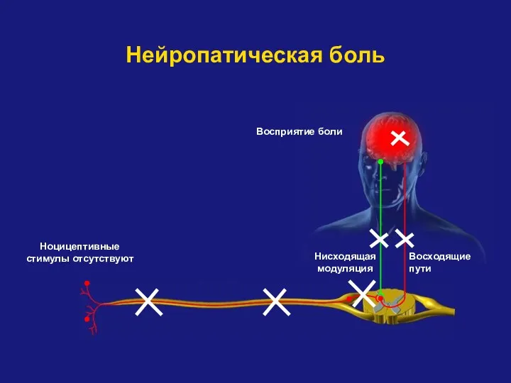 Нисходящая модуляция Восходящие пути Восприятие боли Нейропатическая боль Ноцицептивные стимулы отсутствуют