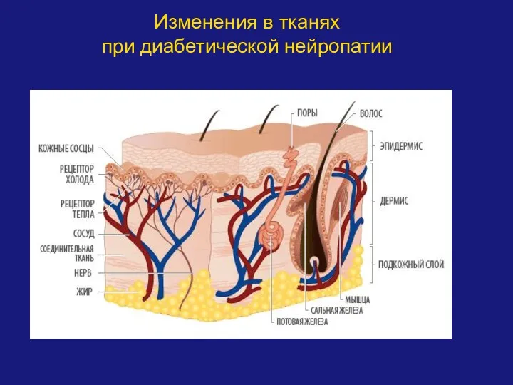 Изменения в тканях при диабетической нейропатии