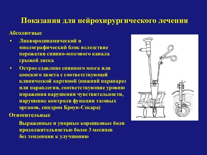 Абсолютные Ликвородинамический и миелографический блок вследствие пережатия спинно-мозгового канала грыжей диска Острое сдавлние