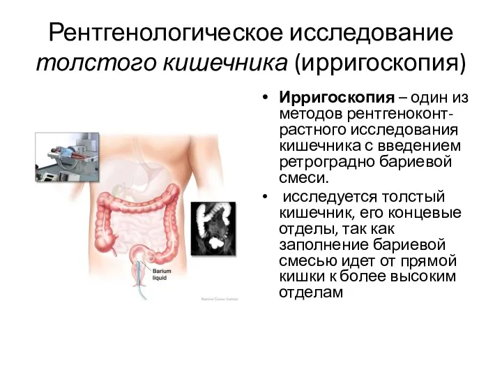 Рентгенологическое исследование толстого кишечника (ирригоскопия) Ирригоскопия – один из методов