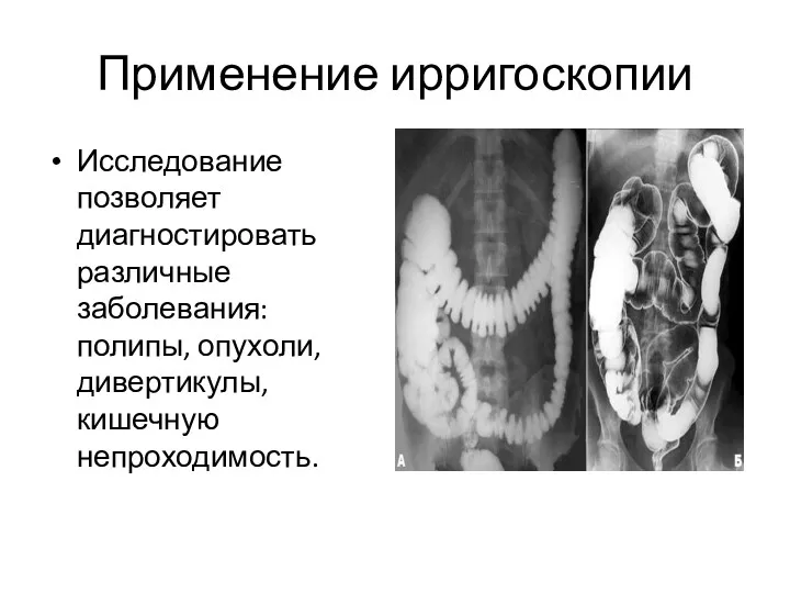 Применение ирригоскопии Исследование позволяет диагностировать различные заболевания: полипы, опухоли, дивертикулы, кишечную непроходимость.