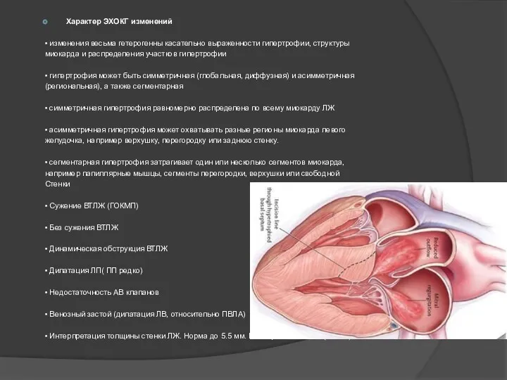 Характер ЭХОКГ изменений • изменения весьма гетерогенны касательно выраженности гипертрофии,