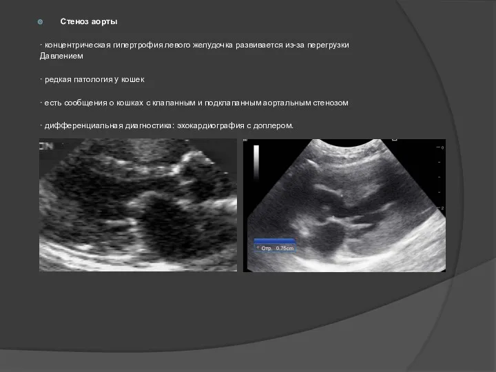 Стеноз аорты · концентрическая гипертрофия левого желудочка развивается из-за перегрузки