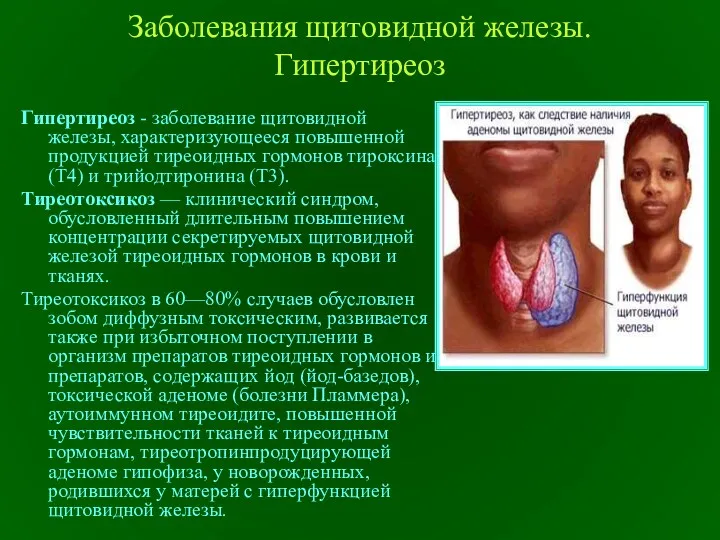 Заболевания щитовидной железы. Гипертиреоз Гипертиреоз - заболевание щитовидной железы, характеризующееся