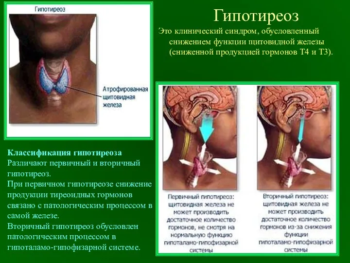 Гипотиреоз Это клинический синдром, обусловленный снижением функции щитовидной железы (сниженной