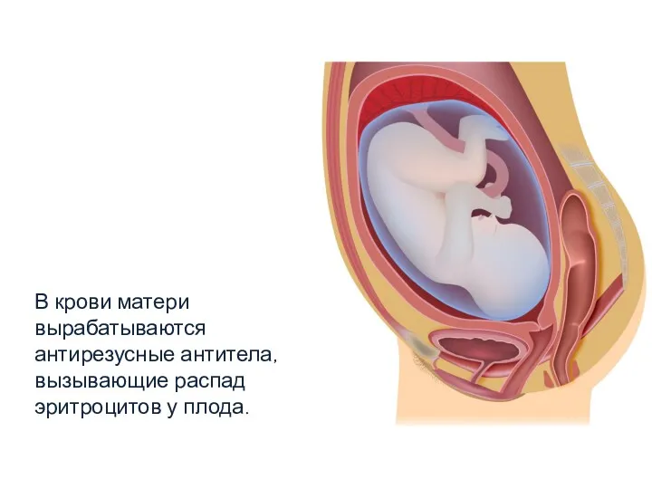 В крови матери вырабатываются антирезусные антитела, вызывающие распад эритроцитов у плода.