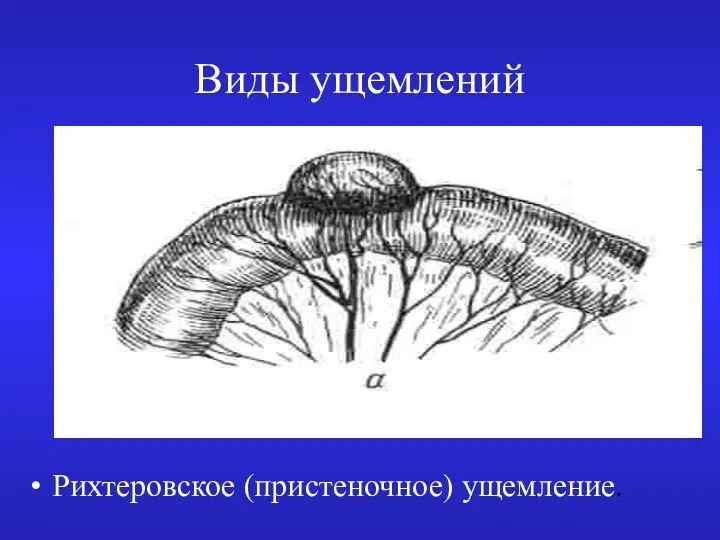 Виды ущемлений Рихтеровское (пристеночное) ущемление.