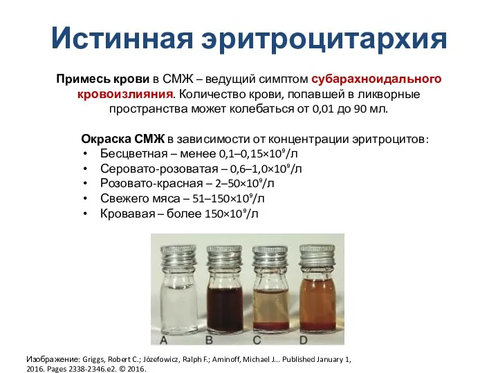 Истинная эритроцитархия Примесь крови в СМЖ – ведущий симптом субарахноидального