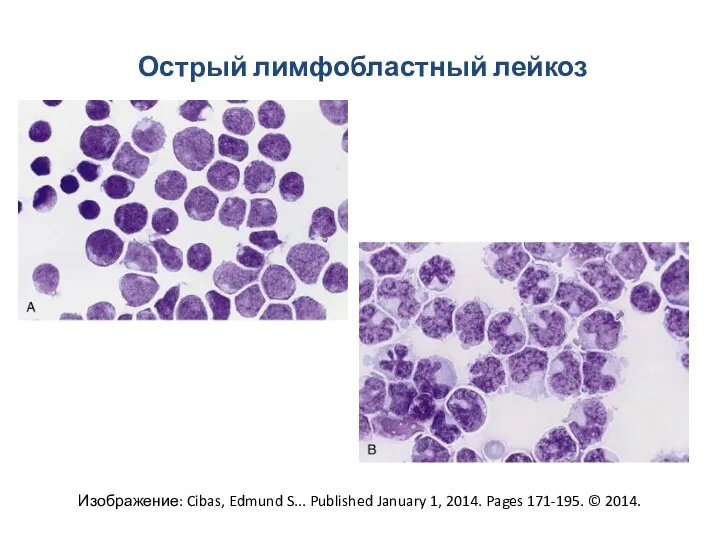 Острый лимфобластный лейкоз Изображение: Cibas, Edmund S... Published January 1, 2014. Pages 171-195. © 2014.