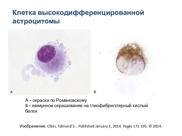 Клетка высокодифференцированной астроцитомы Изображение: Cibas, Edmund S... Published January 1,