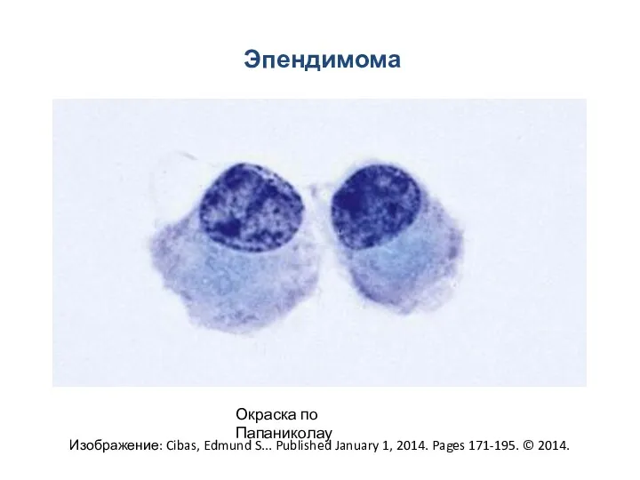 Эпендимома Изображение: Cibas, Edmund S... Published January 1, 2014. Pages 171-195. © 2014. Окраска по Папаниколау