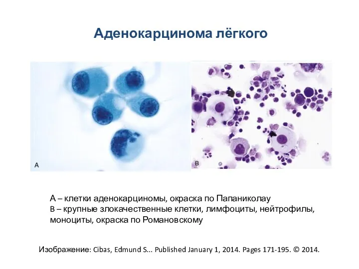 Аденокарцинома лёгкого Изображение: Cibas, Edmund S... Published January 1, 2014.