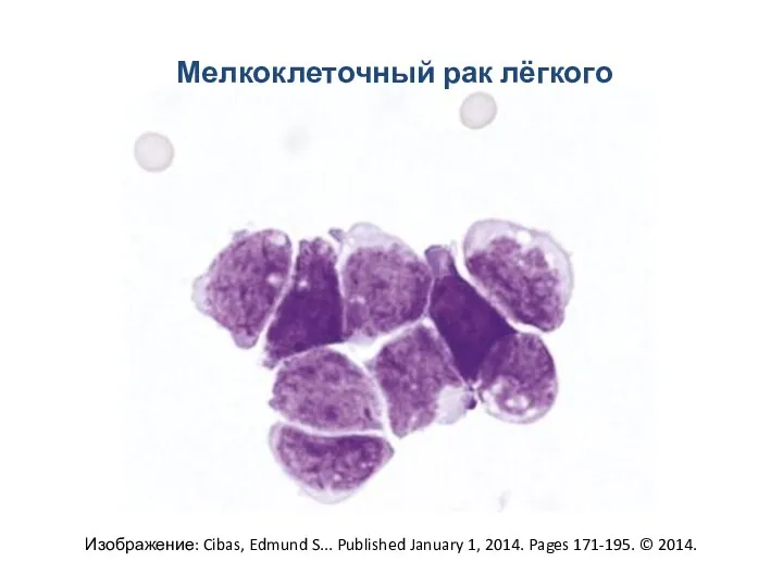 Мелкоклеточный рак лёгкого Изображение: Cibas, Edmund S... Published January 1, 2014. Pages 171-195. © 2014.