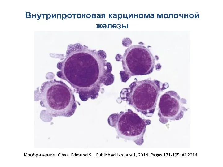 Внутрипротоковая карцинома молочной железы Изображение: Cibas, Edmund S... Published January 1, 2014. Pages 171-195. © 2014.