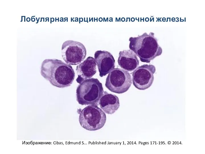 Лобулярная карцинома молочной железы Изображение: Cibas, Edmund S... Published January 1, 2014. Pages 171-195. © 2014.