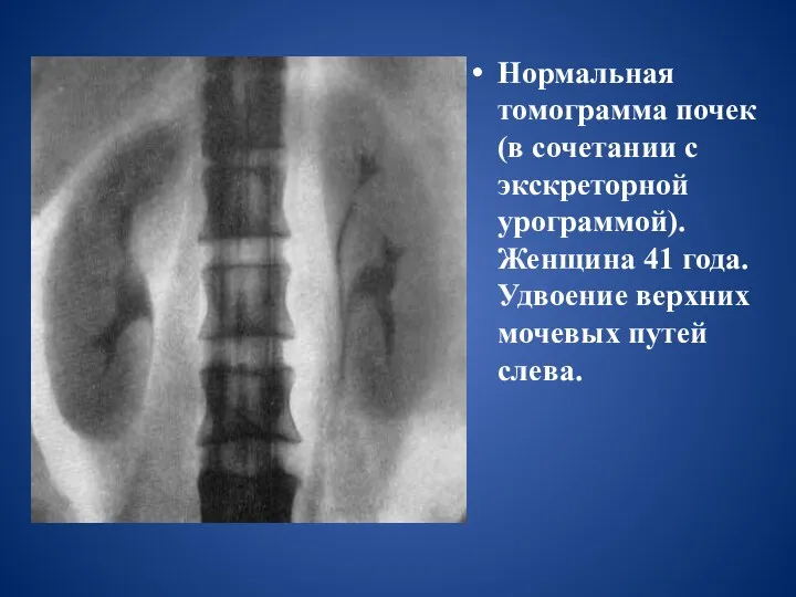 Нормальная томограмма почек (в сочетании с экскреторной урограммой). Женщина 41 года. Удвоение верхних мочевых путей слева.