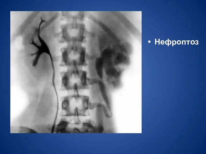 Нефроптоз