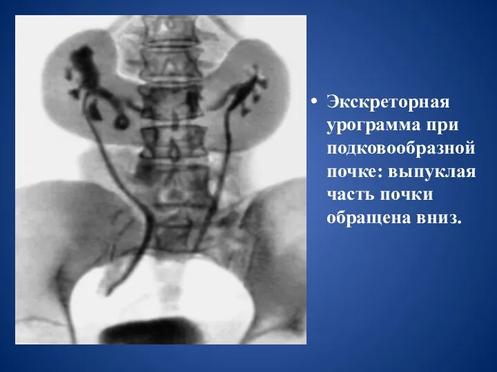 Экскреторная урограмма при подковообразной почке: выпуклая часть почки обращена вниз.