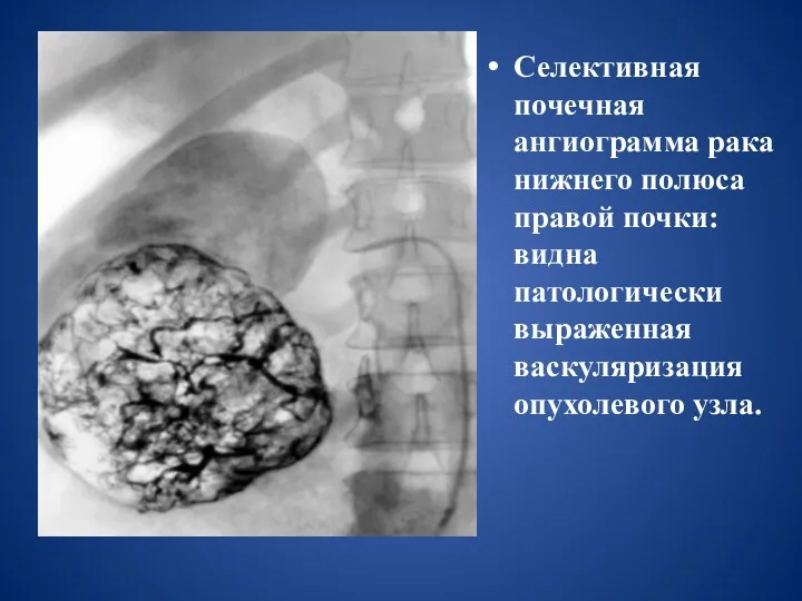 Селективная почечная ангиограмма рака нижнего полюса правой почки: видна патологически выраженная васкуляризация опухолевого узла.