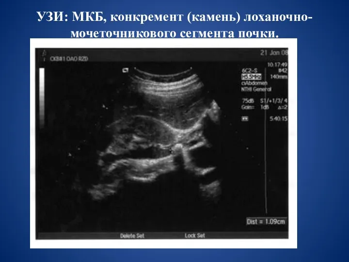 УЗИ: МКБ, конкремент (камень) лоханочно-мочеточникового сегмента почки.