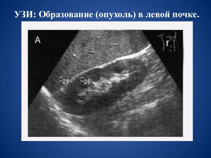 УЗИ: Образование (опухоль) в левой почке.