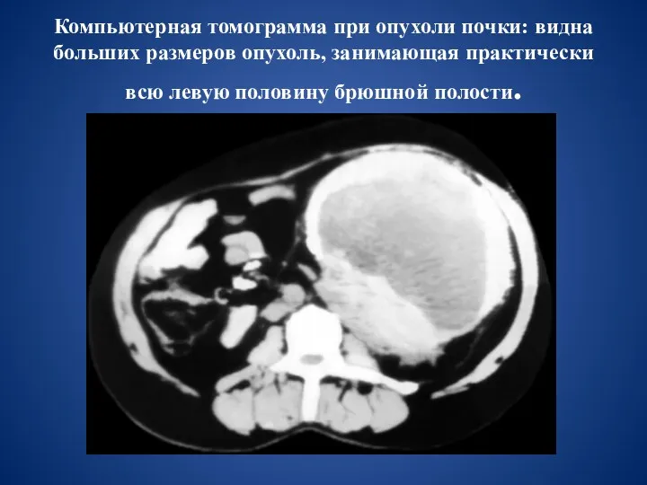 Компьютерная томограмма при опухоли почки: видна больших размеров опухоль, занимающая практически всю левую половину брюшной полости.