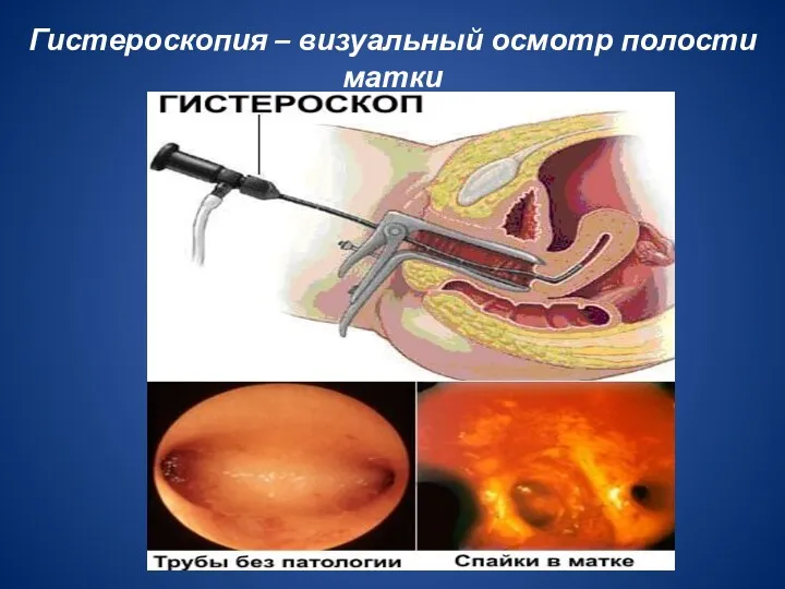 Гистероскопия – визуальный осмотр полости матки