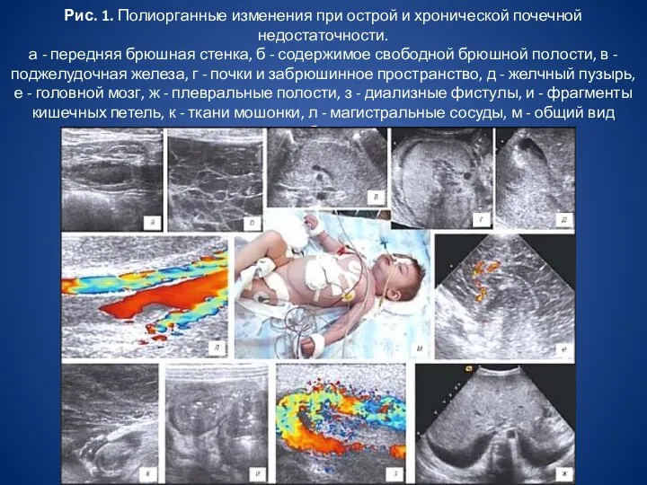 Рис. 1. Полиорганные изменения при острой и хронической почечной недостаточности.