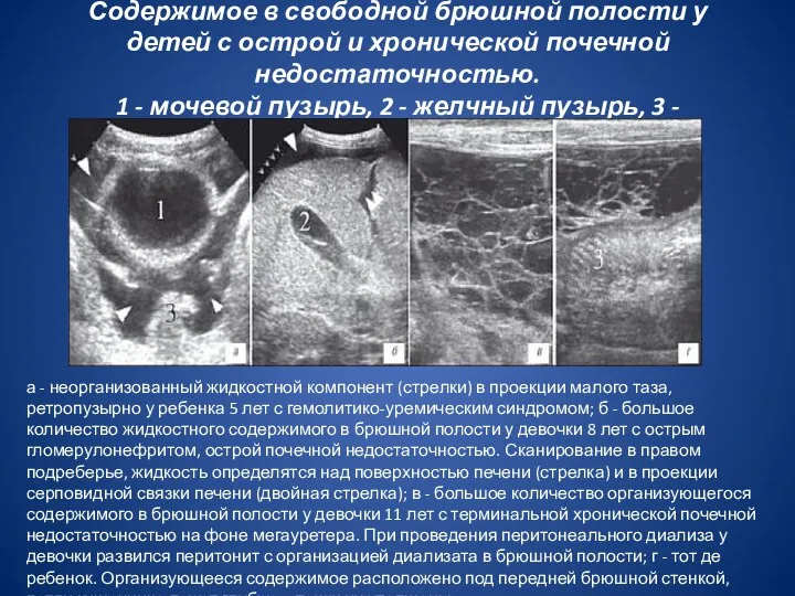 Содержимое в свободной брюшной полости у детей с острой и