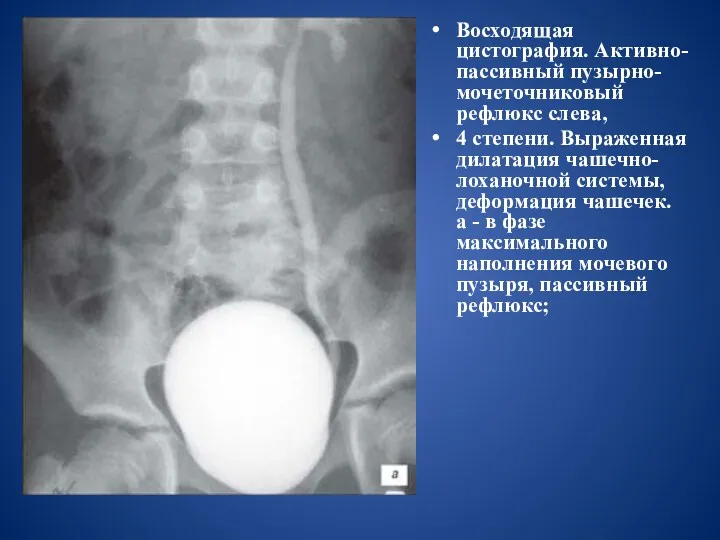 Восходящая цистография. Активно-пассивный пузырно-мочеточниковый рефлюкс слева, 4 степени. Выраженная дилатация