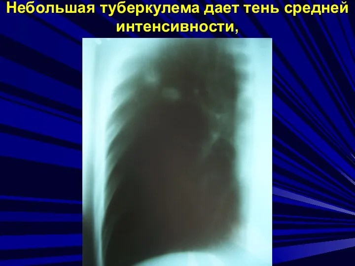 МФ БГУ Мархаев А.Г. Небольшая туберкулема дает тень средней интенсивности,