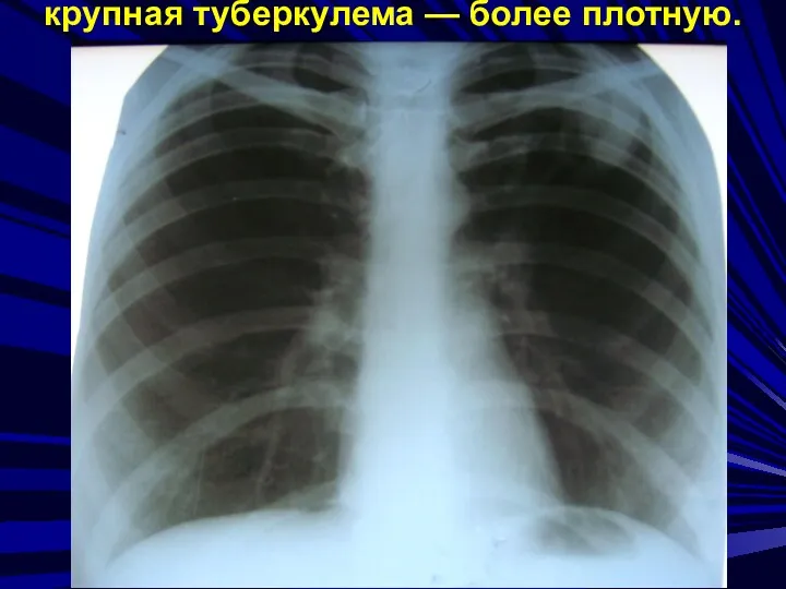 МФ БГУ Мархаев А.Г. крупная туберкулема — более плотную.