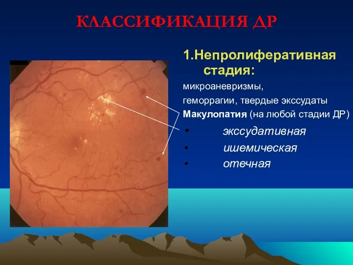 КЛАССИФИКАЦИЯ ДР 1.Непролиферативная стадия: микроаневризмы, геморрагии, твердые экссудаты Макулопатия (на любой стадии ДР) экссудативная ишемическая отечная