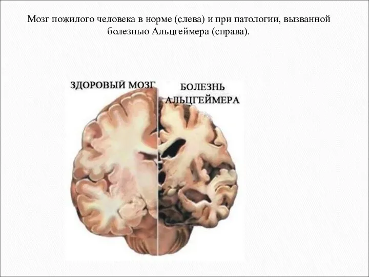 Мозг пожилого человека в норме (слева) и при патологии, вызванной болезнью Альцгеймера (справа).