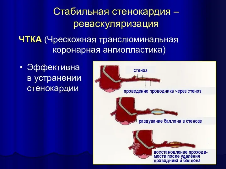 Стабильная стенокардия – реваскуляризация ЧТКА (Чрескожная транслюминальная коронарная ангиопластика) Эффективна в устранении стенокардии