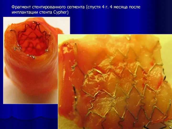 Фрагмент стентированного сегмента (спустя 4 г. 4 месяца после имплантации стента Cypher)