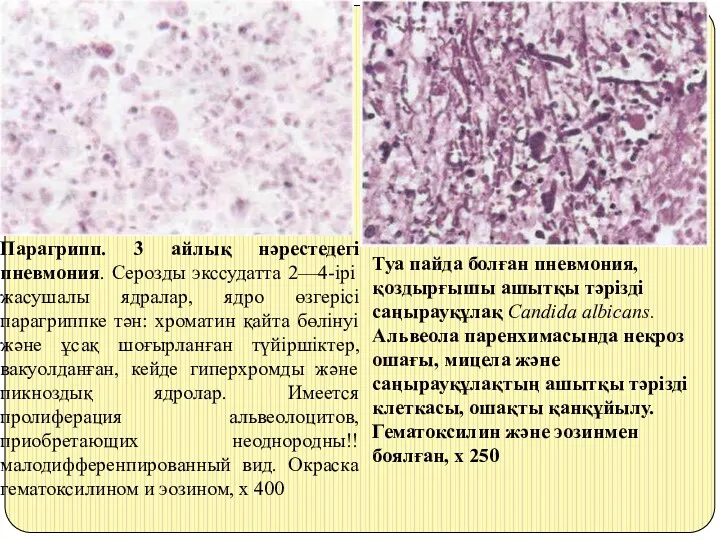 Туа пайда болған пневмония, қоздырғышы ашытқы тәрізді саңырауқұлақ Candida albicans. Альвеола паренхимасында некроз