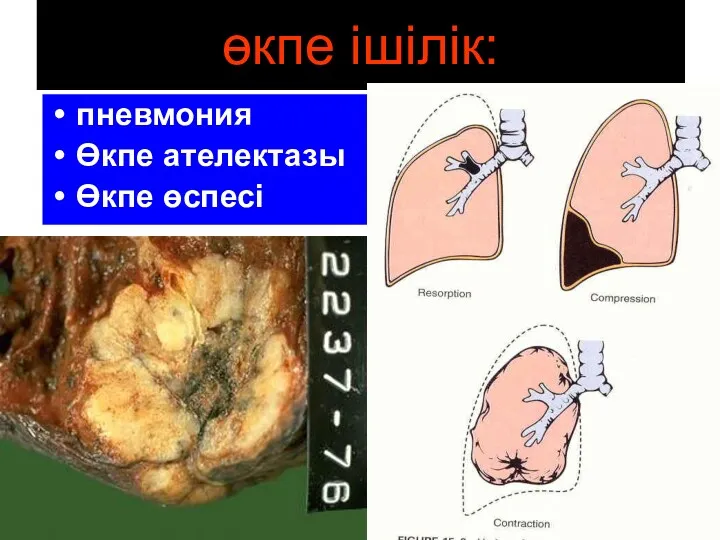 өкпе ішілік: пневмония Өкпе ателектазы Өкпе өспесі