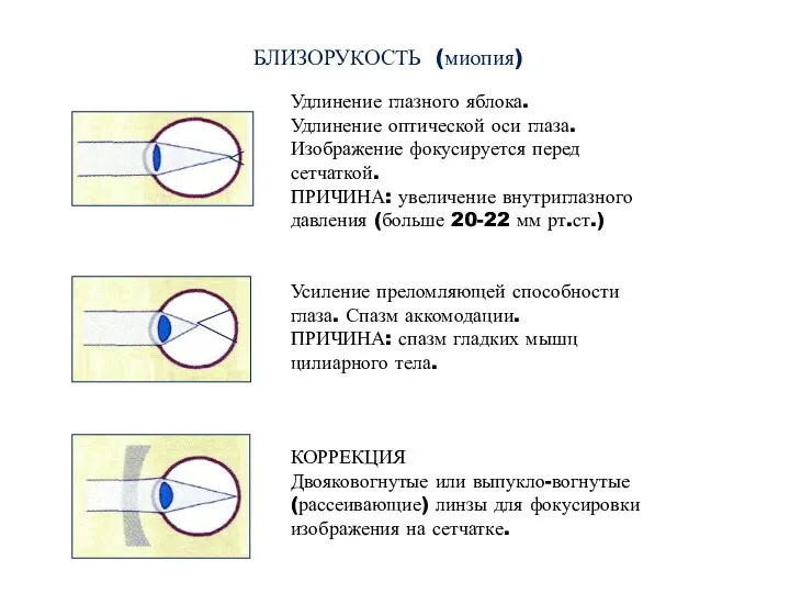 БЛИЗОРУКОСТЬ (миопия) Удлинение глазного яблока. Удлинение оптической оси глаза. Изображение