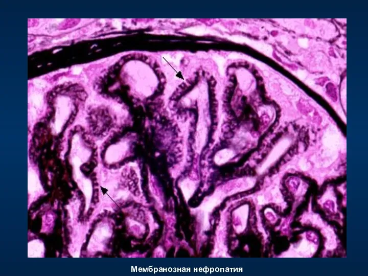 Мембранозная нефропатия