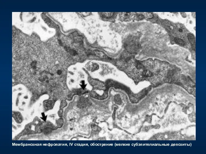 Мембранозная нефропатия, IV стадия, обострение (мелкие субэпителиальные депозиты)